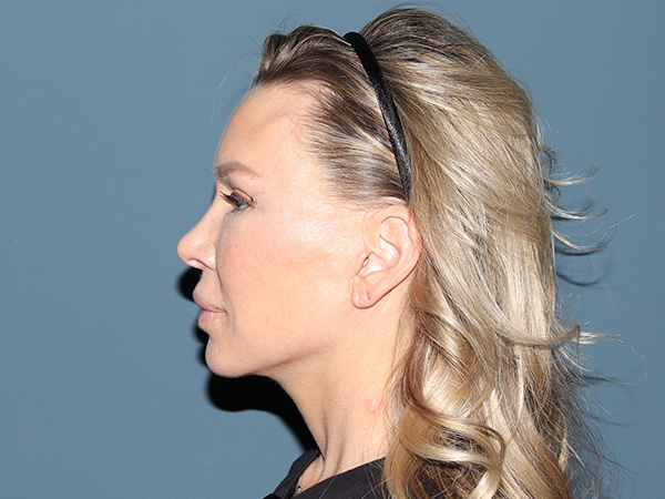 Brow Lift Before & After Gallery - Patient 304309 - Image 6