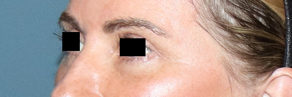 Eyelid Surgery Before & After Gallery - Patient 204288 - Image 4
