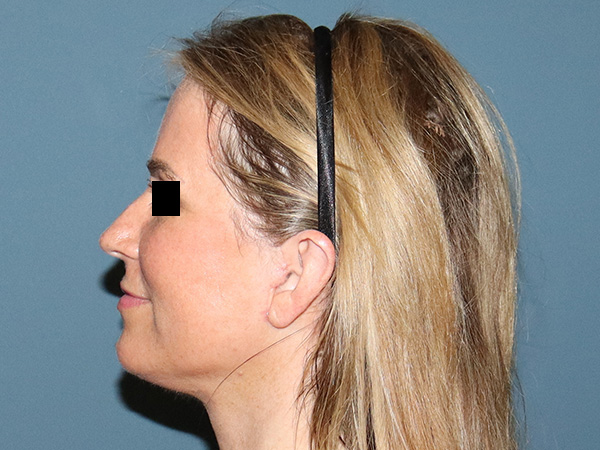 Facelift Before & After Gallery - Patient 274005 - Image 4