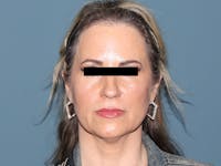 Fractional CO2 Laser Resurfacing Before & After Gallery - Patient 308222 - Image 1