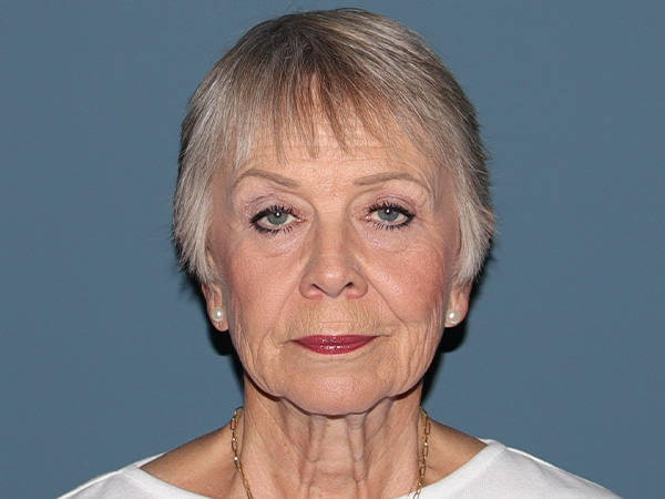 Fractional CO2 Laser Resurfacing Before & After Gallery - Patient 224581 - Image 1