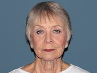 Fractional CO2 Laser Resurfacing Before & After Gallery - Patient 224581 - Image 1