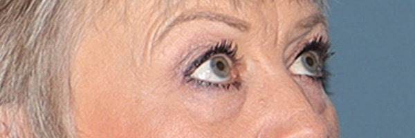 Eyelid Surgery Before & After Gallery - Patient 154346 - Image 4