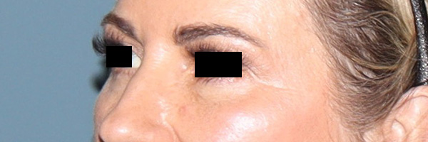 Eyelid Surgery Before & After Gallery - Patient 204288 - Image 3