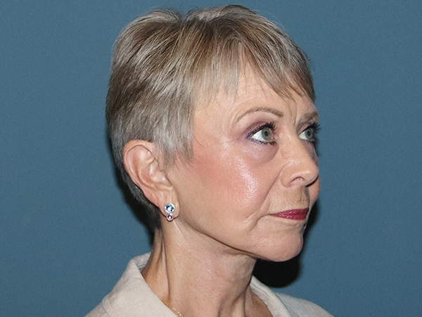 Facelift Before & After Gallery - Patient 395065 - Image 2