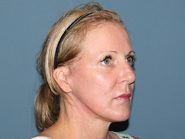 Facelift Before & After Gallery - Patient 377440 - Image 2