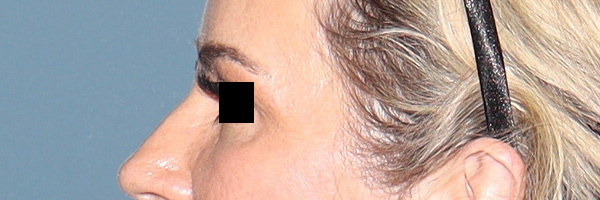 Eyelid Surgery Before & After Gallery - Patient 204288 - Image 5
