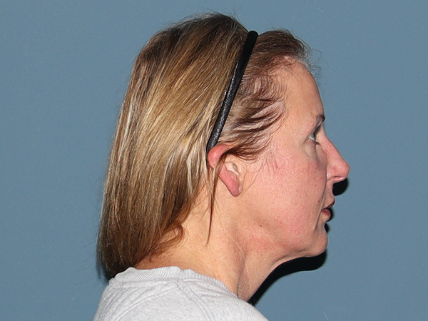 Facelift Before & After Gallery - Patient 377440 - Image 3