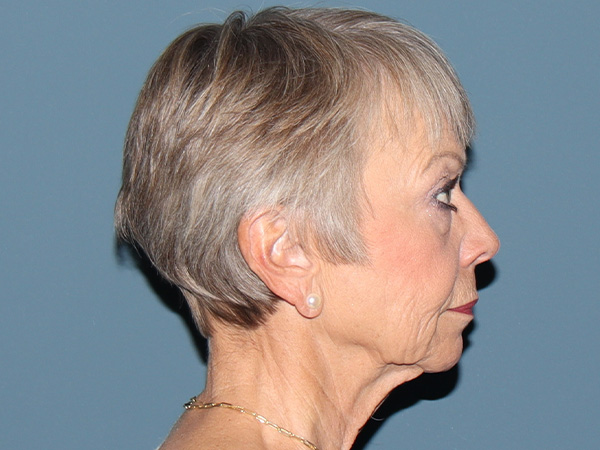 Facelift Before & After Gallery - Patient 395065 - Image 3