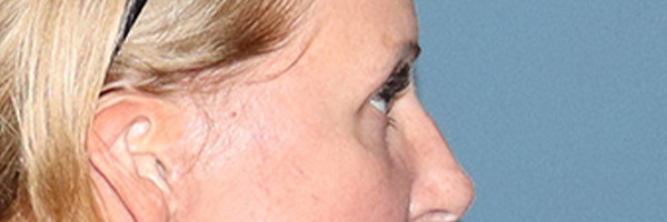 Eyelid Surgery Before & After Gallery - Patient 244874 - Image 6