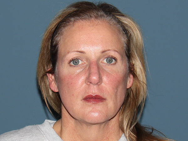 Fractional CO2 Laser Resurfacing Before & After Gallery - Patient 342677 - Image 1