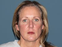 Fractional CO2 Laser Resurfacing Before & After Gallery - Patient 342677 - Image 1