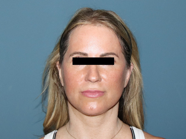 Facelift Before & After Gallery - Patient 274005 - Image 6