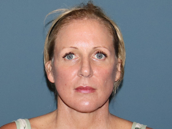 Facelift Before & After Gallery - Patient 377440 - Image 6