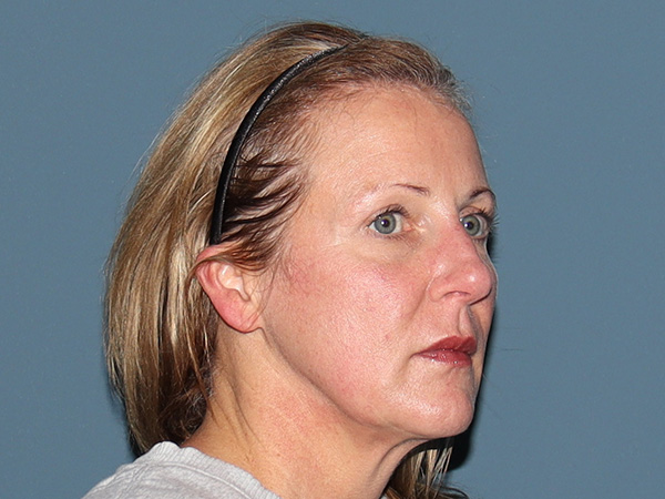 Neck Lift Before & After Gallery - Patient 124457 - Image 1