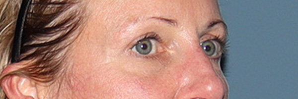Eyelid Surgery Before & After Gallery - Patient 244874 - Image 3