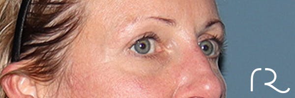 Harkaran Rana Patient 244874 | Our Gallery | Rana Facial Plastic Surgery