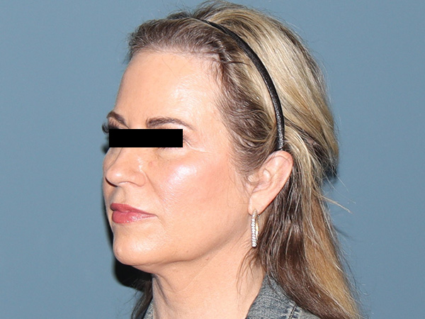 Neck Lift Before & After Gallery - Patient 121864 - Image 1