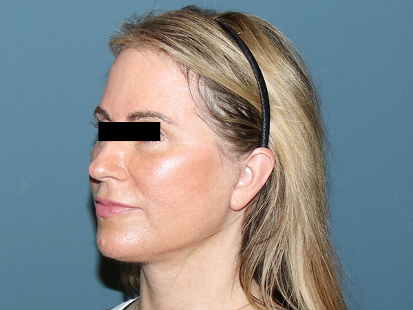 Facelift Before & After Gallery - Patient 274005 - Image 2