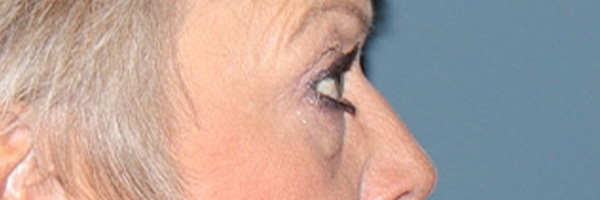 Eyelid Surgery Before & After Gallery - Patient 154346 - Image 5