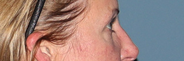 Eyelid Surgery Before & After Gallery - Patient 244874 - Image 5