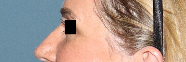 Eyelid Surgery Before & After Gallery - Patient 204288 - Image 6
