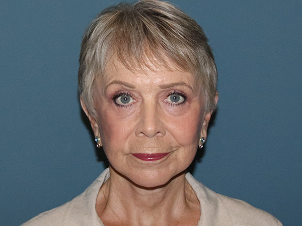 Facelift Before & After Gallery - Patient 395065 - Image 6