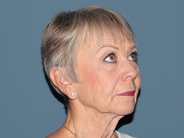 Neck Lift Before & After Gallery - Patient 423872 - Image 1