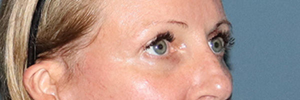 Eyelid Surgery Before & After Gallery - Patient 244874 - Image 4