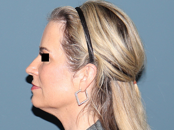 Facelift Before & After Gallery - Patient 274005 - Image 3