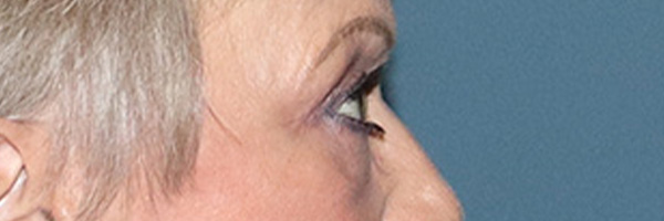 Eyelid Surgery Before & After Gallery - Patient 154346 - Image 6