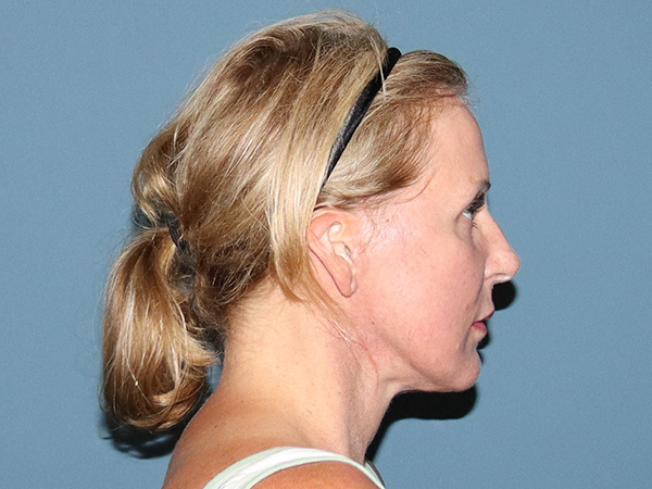 Facelift Before & After Gallery - Patient 377440 - Image 4