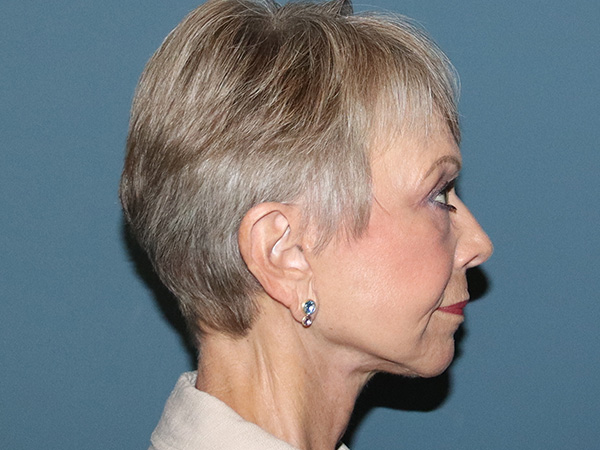 Facelift Before & After Gallery - Patient 395065 - Image 4