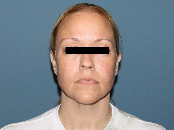 Facelift Before & After Gallery - Patient 162466 - Image 5