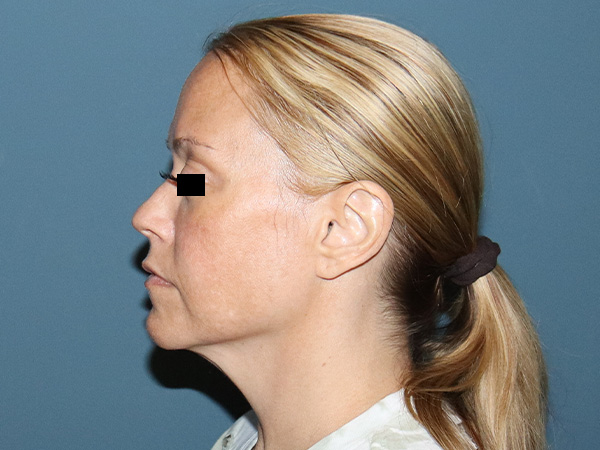 Facelift Before & After Gallery - Patient 162466 - Image 3