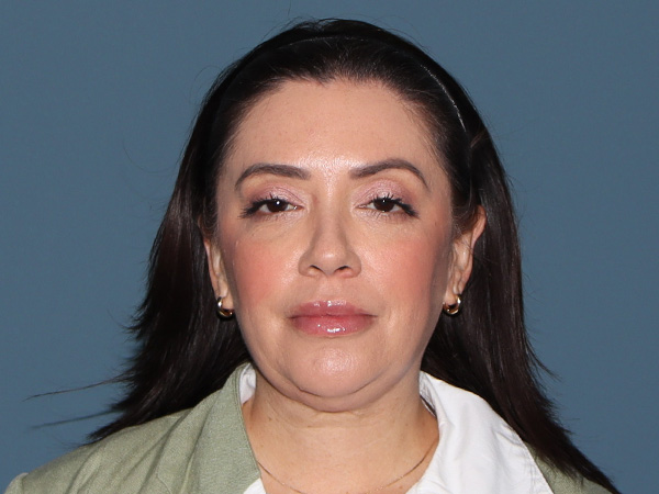 Facelift Before & After Gallery - Patient 171724 - Image 5