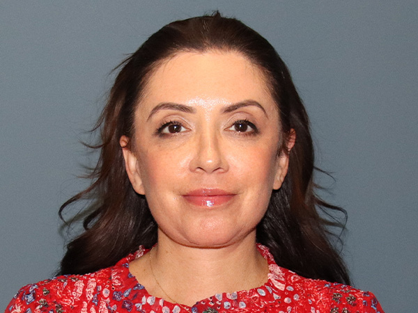 Facelift Before & After Gallery - Patient 171724 - Image 6