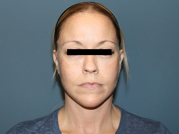 Facelift Before & After Gallery - Patient 162466 - Image 6