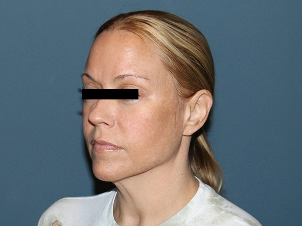 Neck Lift Before & After Gallery - Patient 103431 - Image 1