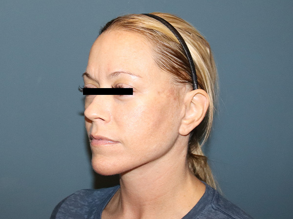 Facelift Before & After Gallery - Patient 162466 - Image 2