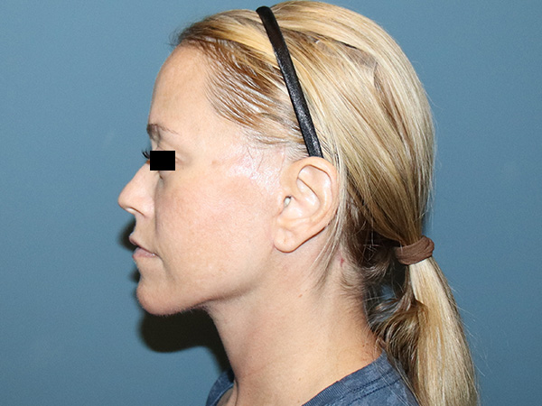 Facelift Before & After Gallery - Patient 162466 - Image 4