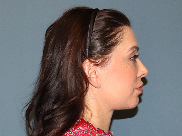 Facelift Before & After Gallery - Patient 171724 - Image 4