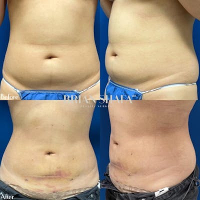 Liposuction Before & After Photos - Patient 40314477 - Image 1