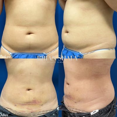 Liposuction Before & After Gallery - Patient 40314477 - Image 1