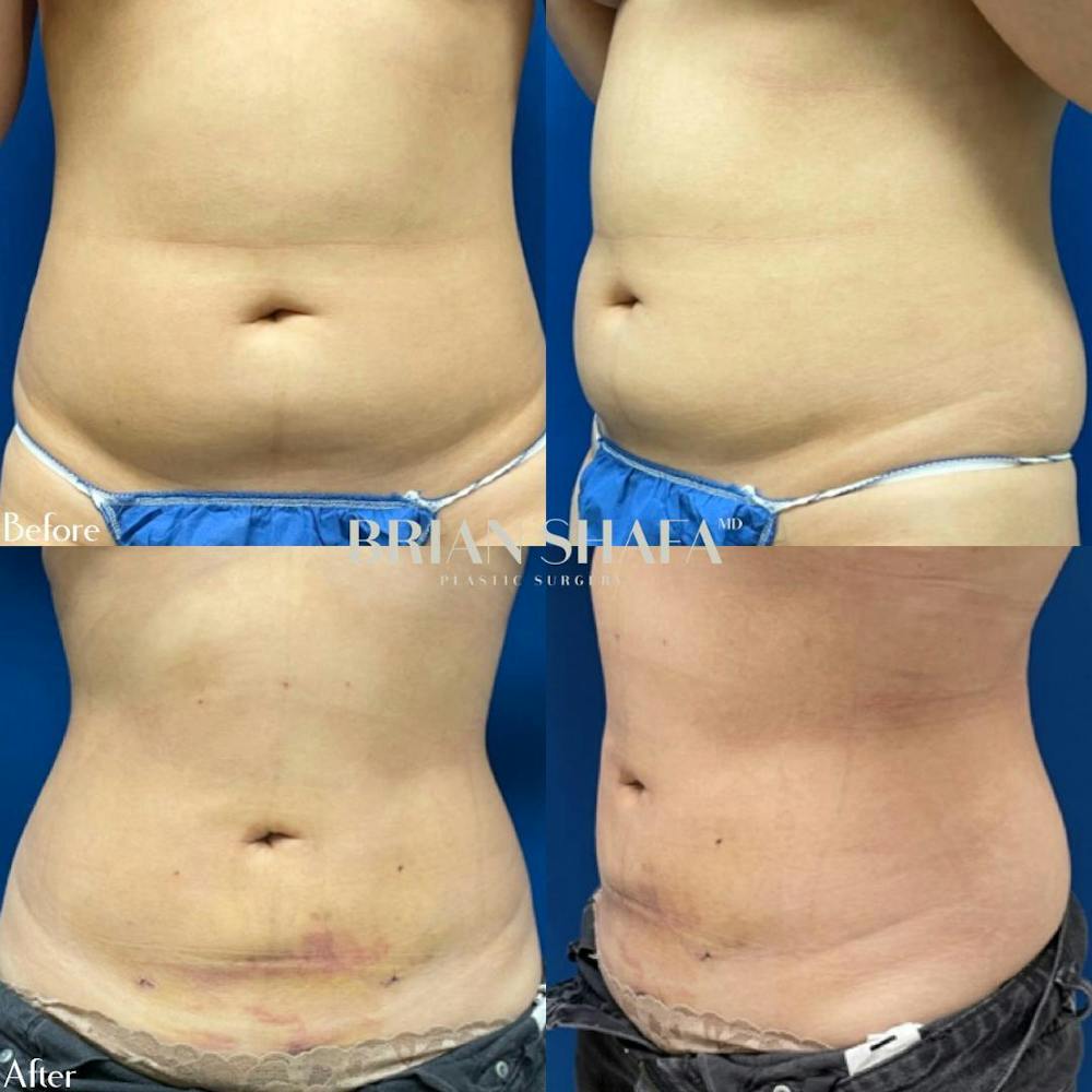 Liposuction Before & After Gallery - Patient 40314477 - Image 1