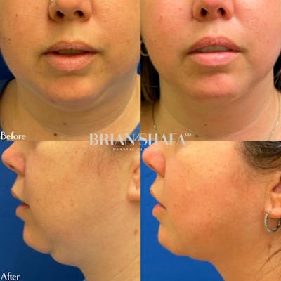 Jawline Contouring  Before & After Gallery - Patient 40314549 - Image 1