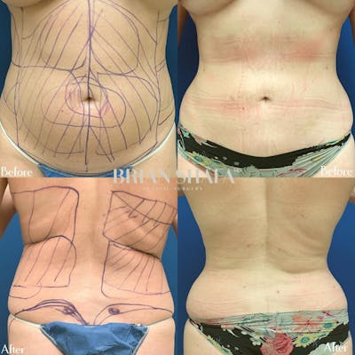 Liposuction Before & After Photos - Patient 40314583 - Image 1