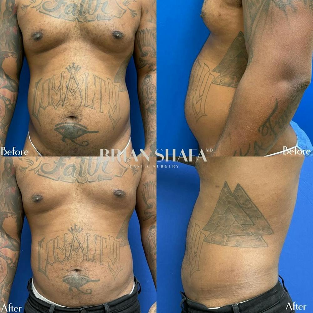 Liposuction Before & After Gallery - Patient 40314612 - Image 1