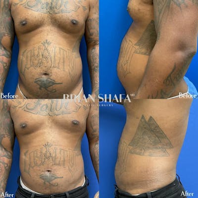 Liposuction Before & After Gallery - Patient 40314612 - Image 1