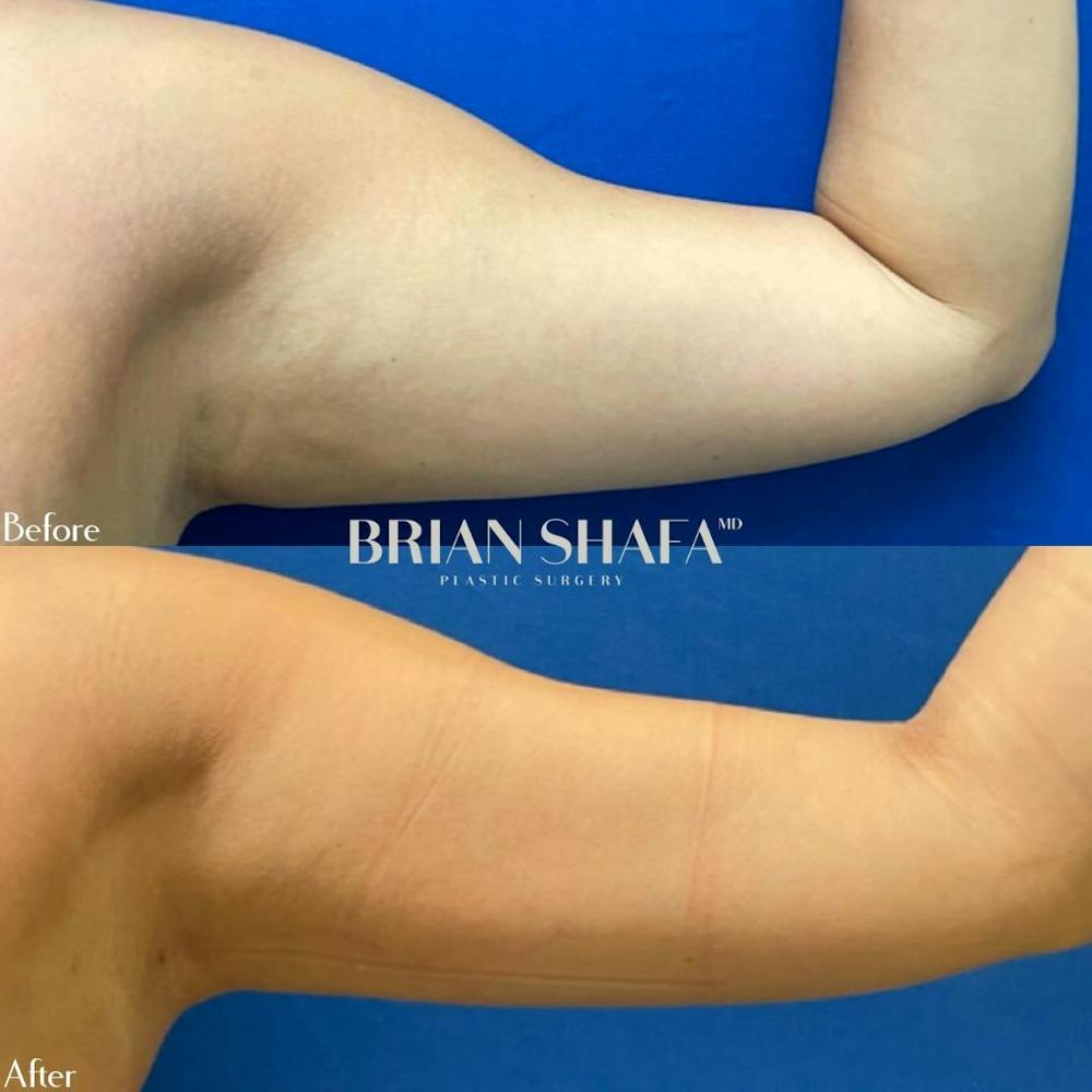 Liposuction Before & After Gallery - Patient 40314625 - Image 1